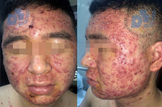 Nam thanh niên 'nát cả người' vì dùng thuốc trị mụn mua trên mạng - ảnh 1