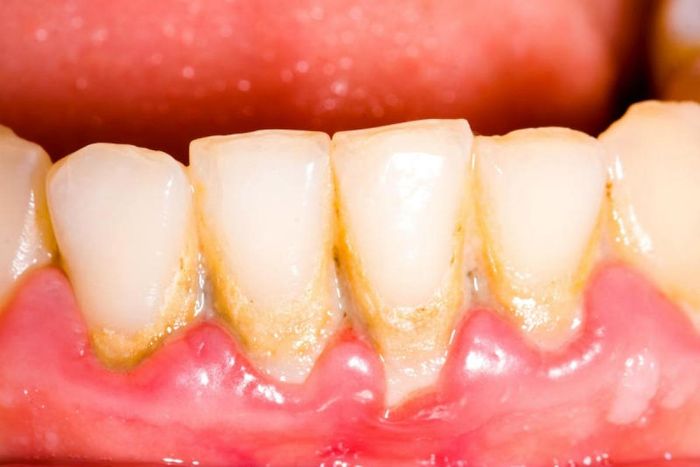 1. Sự tích tụ mảng bám: Mảng bám tích tụ trên răng nếu bạn thực hiện vệ sinh răng miệng kém và không thường xuyên đánh răng, dùng chỉ nha khoa hoặc súc miệng. Vi khuẩn trong mảng bám có thể ăn mòn men răng và gây sâu răng. Tuy nhiên, các vấn đề lớn hơn sẽ phát sinh nếu mảng bám biến thành cao răng. Cao răng là một lớp vỏ cứng màu vàng nhạt, thường được gọi là vôi răng, phát triển cả bên dưới và bên trên đường viền nướu. Giải pháp cho lí do này là hãy vệ sinh răng miệng thường xuyên và đúng cách.